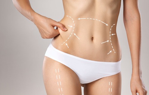 6 Ways to Keep Your Liposuction Results mahdadmedtour