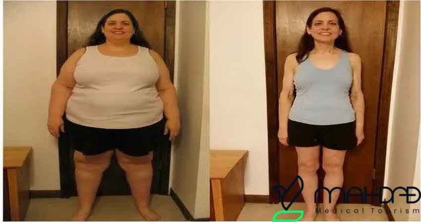 How much weight is lost after weight loss surgery?